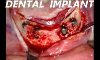 ileri-implant-cerrahisi-implant-dis-hekimi-mustafa-guven-izle-video