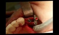 implant-dis-ameliyati-nasil-yapilir--implant-kemik-tozu-bone-spreading-bone-splitting-izle-video