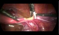 total-laparoscopic-hysterectomy-and-removal-of-both-ovaries