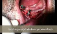 ileri-cerrahi-implant-dis-ameliyati-bone-splitting-implant-dis-ameliyati-implant-yapimi-izle-video