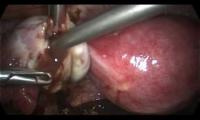 laparoskopik-cikolata-kisti-laparoscopic-cyctectomy-for-endometrioma