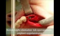 implant-tedavisi-implant-cerrahisi-implant-dis-ameliyati-izle-implant-dis-nasil-yapilir-izle-video