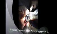 implant-ameliyati-izle-video